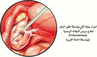 عملية الكي بواسطة ناظور البطن لعلاج مرض البطانة الرحمية ( بواسطة اشعة الليزر